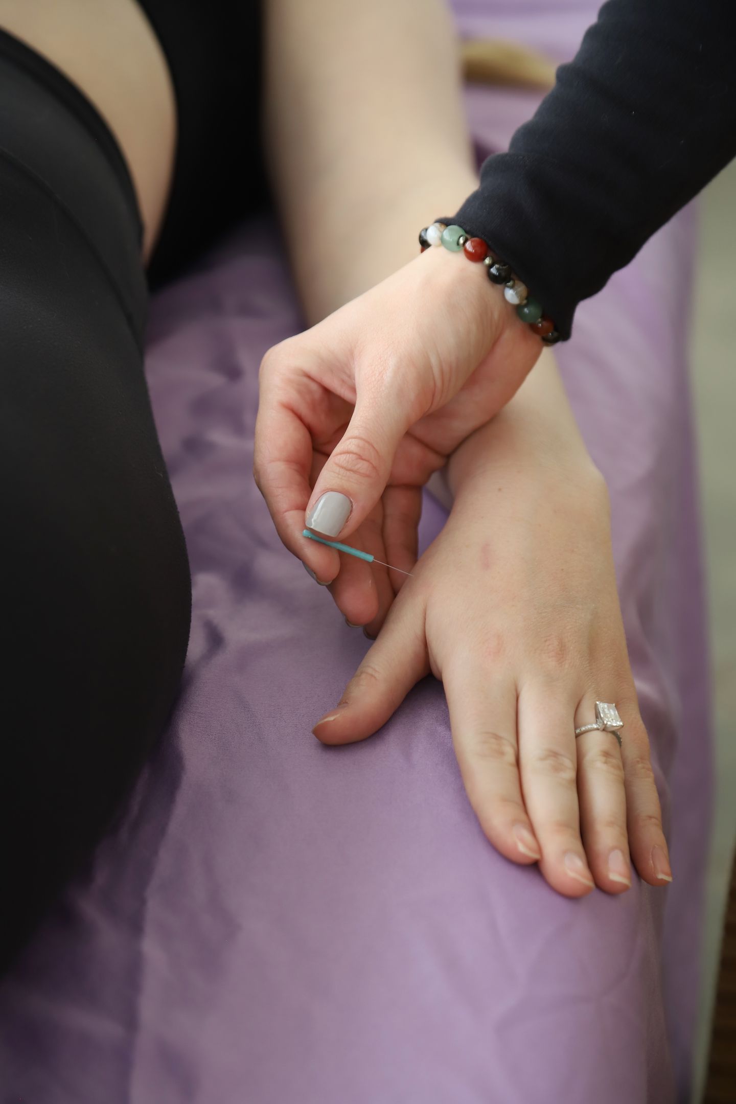 Acupuncture in Hand