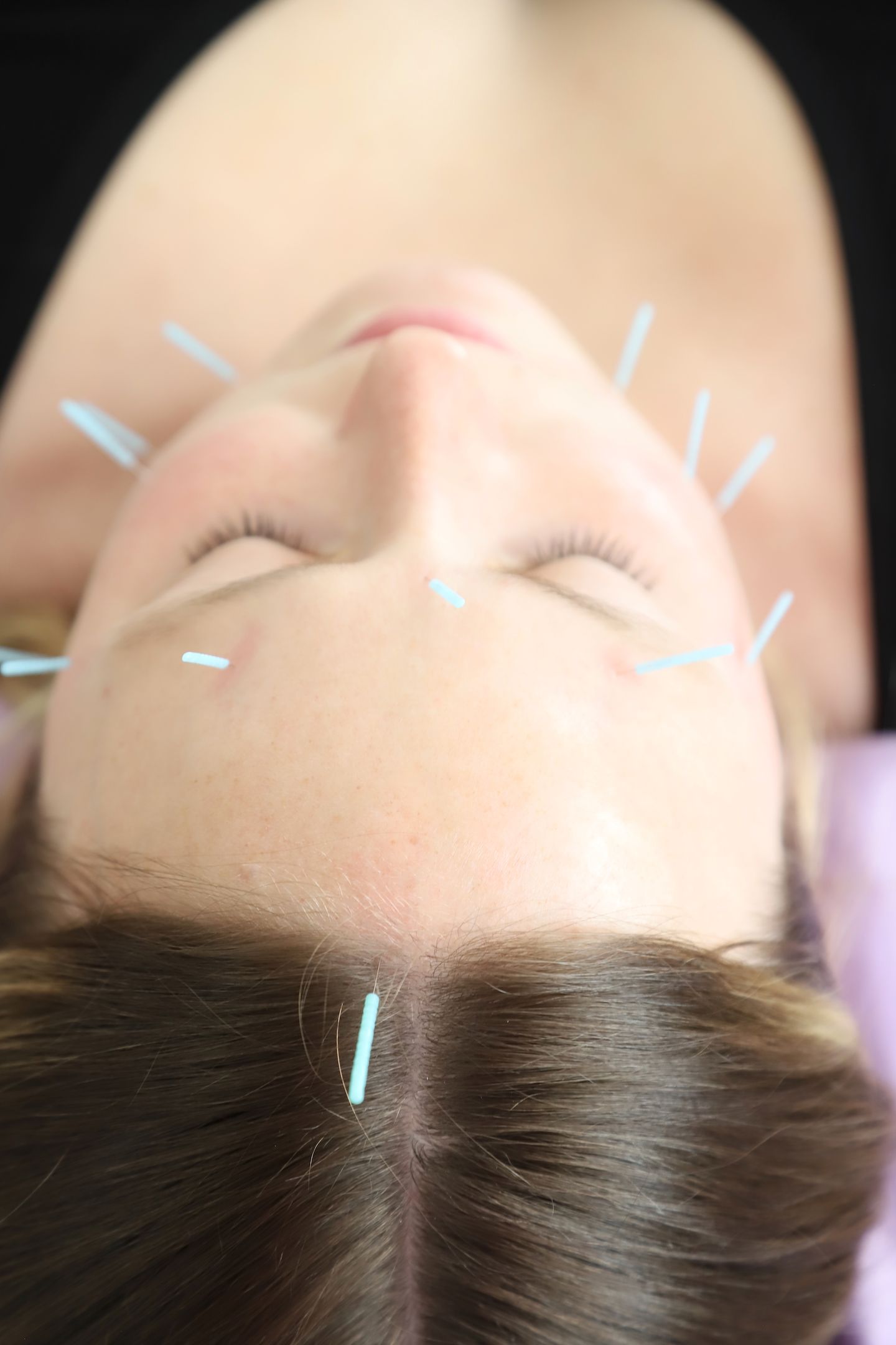 Face Acupuncture
