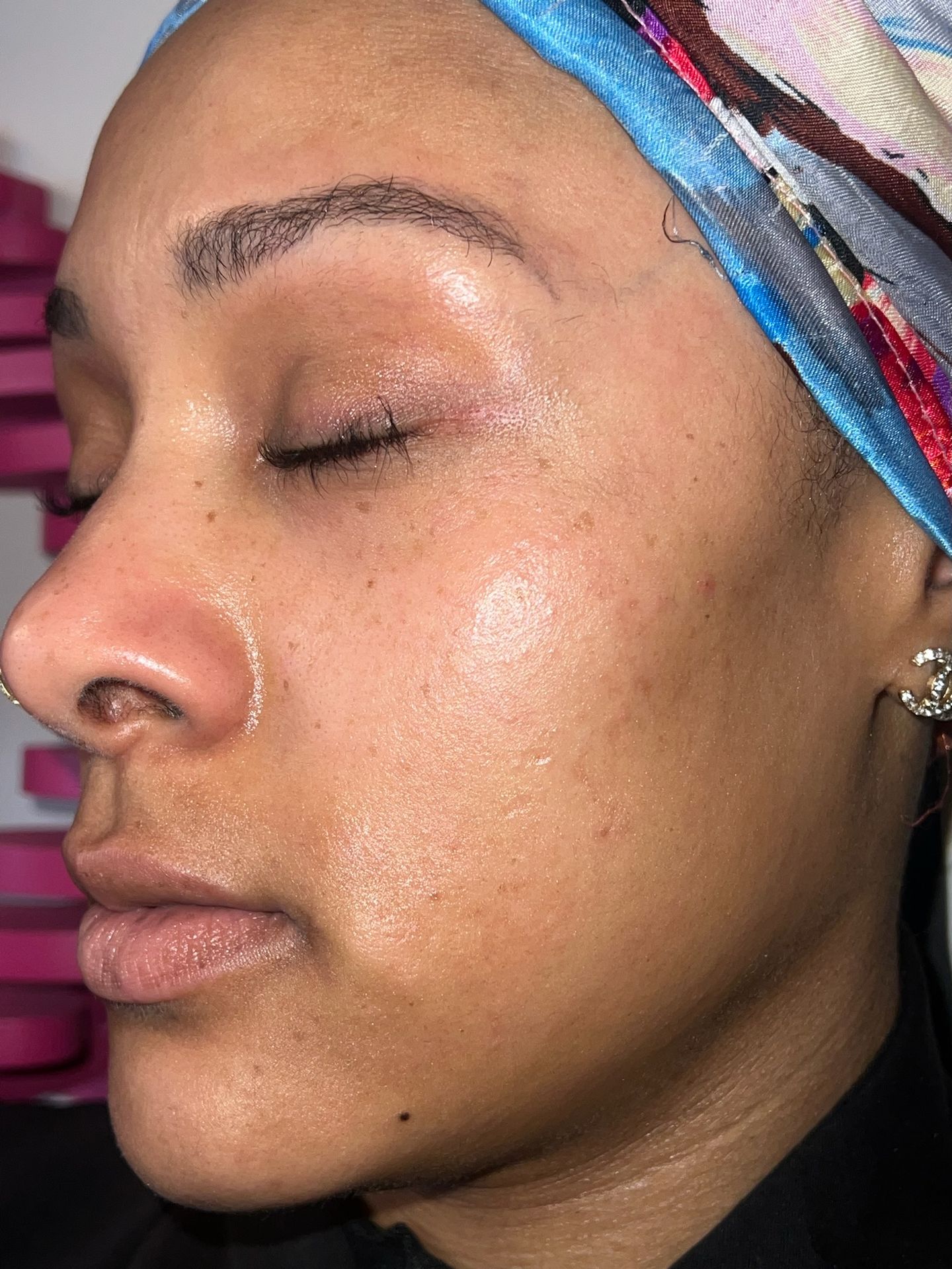 Dermaplaning 
